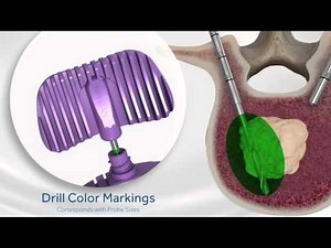 OsteoCool RF Ablation Animation