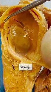 THIS IS THE LABRUM (SEEN ON A REAL SHOULDER) #anatomicalpills