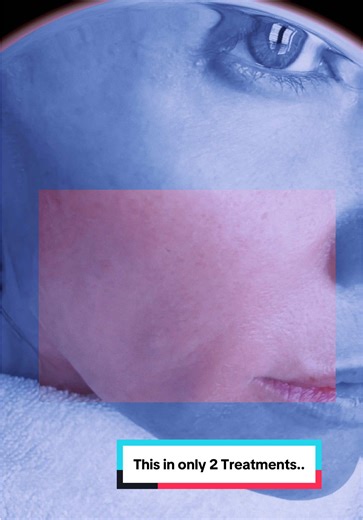 Experiencing Micro Needling: My Second Appointment