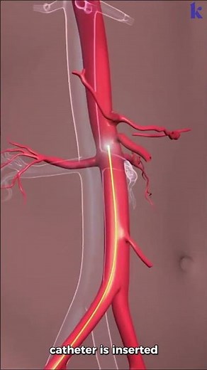 How Brain Clot Is Removed? (3D Animation). Mechanical Thrombectomy For Acute Ischemic Stroke.