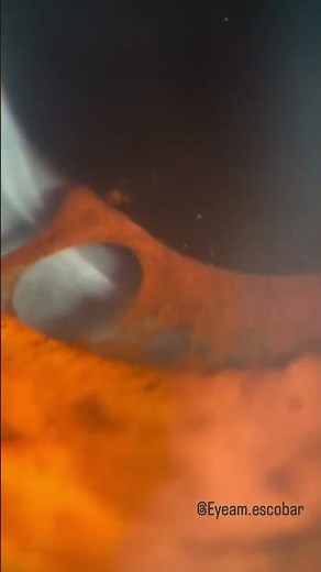 Posterior synechiae are adhesions between the iris and the lens of the eye.