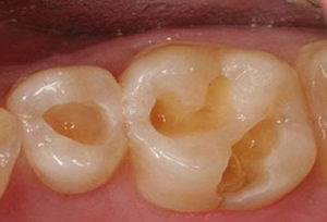 Composite dentaire : Déroulement, explications, vidéo