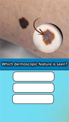 Dermoscopy quiz 5 #medstudent #dermatology