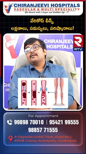 1.7K views | Varicose Veins | Symptoms, Problems, Solutions! | Chiranjeevi Hospitals | Laser Ablation | RTV | RTV Digital | Facebook