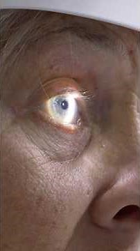 NIH-Funded Research Uncovers Stem Cell Therapy Treatment for Vision Loss - From Labs to Lives