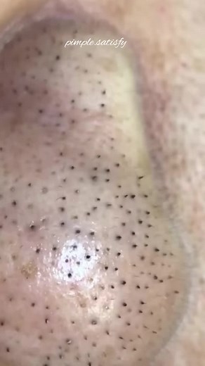 Amazing 😍 #explorاكسبلور #fyp #satisfied #explor #pourtoi #satisfying #pourtoi #blackheads @Relax day @Relax day @Relax day
