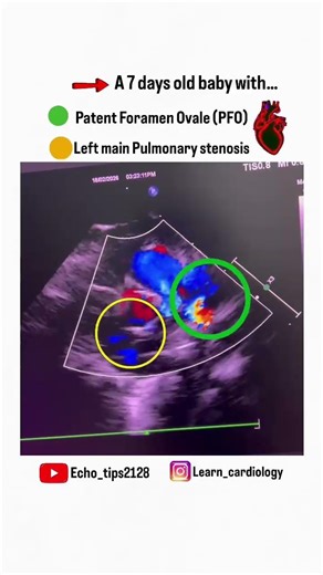 A 7 years old baby diagnosis with PDA and PFO. #cardiology#echocardiography #youtubeshorts #viral