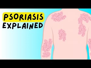 What is Psoriasis? Definition, Etiology, Classification, Pathophysiology, Diagnosis, Treatment