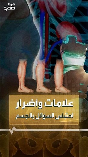 علامات وأضرار احتباس السوائل بالجسم