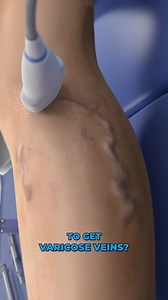 What causes varicose veins？ (3D Animation). #doctor #documentaryphotography #DoctorWho # reel # shorts #DoctorWh# | SMART Doctor