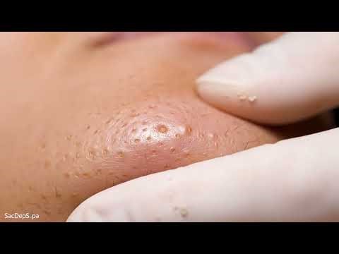 Watch Me Remove The Most Stubborn Blackheads! (Oddly Addictive) 🤩💯