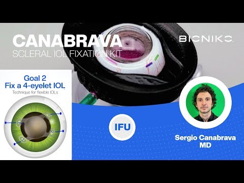 BIONIKO CANABRAVA KIT - Four flanged technique #2 - Foldable IOL (four eyelets)