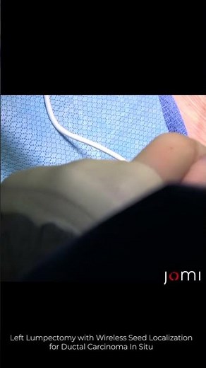 Left Lumpectomy with Wireless Seed Localization for Ductal Carcinoma In Situ