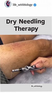 medical on Instagram: "✅ What is Dry Needling? Dry needling involves inserting very thin, sterile needles into trigger points or tight, painful areas in your muscles. These trigger points are often referred to as "muscle knots" and can cause pain, stiffness, and restricted movement. 🎯 Purpose of Dry Needling: Relieve muscle pain and tightness Release trigger points Improve range of motion Increase blood flow and promote healing Treat sports injuries, back pain, neck pain, shoulder pain, etc. 🧠