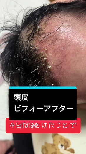 赤ちゃんのための頭皮ケア：牛乳石鹸の効果