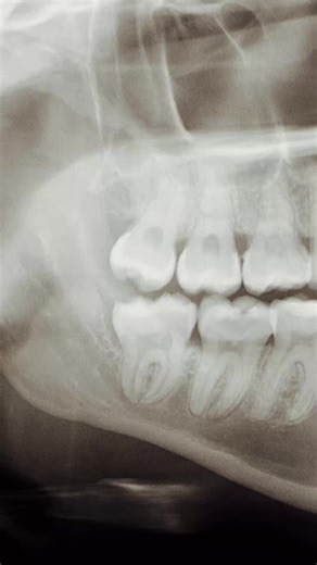Most people think wisdom tooth surgery has to mean IV sedation… But what if I told you these two separate surgical extraction cases were done with nothing more than local anesthetic? No IV. No panic. 🫨 No “I felt that.” No trauma. And the craziest part is… the difference isn’t the patient. It’s the anesthesia. When profound numbness is predictable, surgery becomes calm… and patients stop fearing dentistry altogether. This is exactly why painless anesthesia has become my #1 internal referral eng