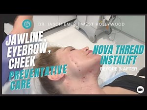 Before & After NovaThread Facelift Procedure: Preventative Care for Jawline, Eyebrow & Cheek