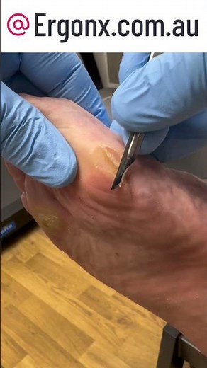 Satisfying Big Toe Hard Skin Removal by Podiatrist Clinic Transformation #FootCare #Podiatry