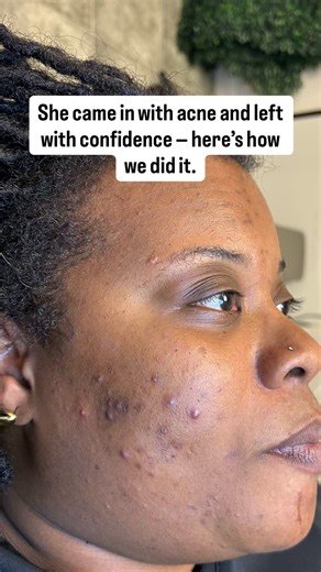 Before working with me, my friend was frustrated with her skin. She told me she recently tried some new products from the drugstore and they broke her out so bad, she knew she had to come see me. After a brief consultation, I developed a treatment plan including a series of chemical peels, one Microchanneling treatment and a targeted skincare regimen to address her acne and pigmentation concerns. Few weeks later, these are her results: ☑️ Skin tone = brightened☑️ Dark spots = diminished ☑️ Infla