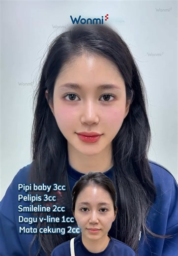 Perawatan HA Injection di WONMI untuk Wajah Ideal