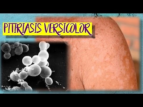 Malassezia furfur Microorganism, Disease and Treatment