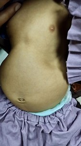 Floppy child with Bell shape chest #sma #myopathy #neuropathy | Dr. Arshad Mehmood - Child Specialist