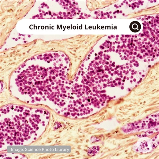 Chronic myeloid leukemia (CML) occurs when a pluripotent stem cell undergoes malignant transformation and clonal myeloproliferation, leading to a striking overproduction of mature and immature granulocytes. Refresh your knowledge: https://mrkmnls.co/3Vm1Qg4 | Merck Manual Professional | Facebook
