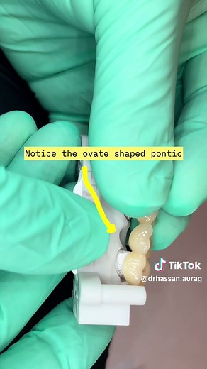 Creating Ovate Pontics for Dental Bridges