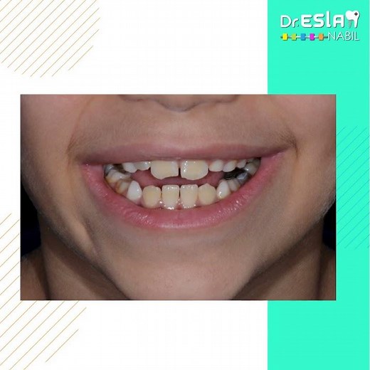 Orthodontic Case | Class 3 face mask treatment | Before and After treatment