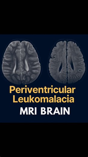 Radiology Verse | MRI Brain Findings in Periventricular Leukomalacia (PVL) | Neonatal White Matter Injury | Radiology Teaching Case 🧩 Periventricular... | Instagram