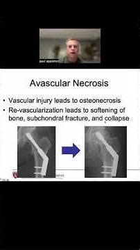 Femoral head blood supply (and why we perform hip hemiarthroplasty)