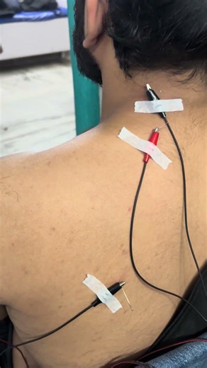 Cervical compression C2to C6 Release with Dry needling