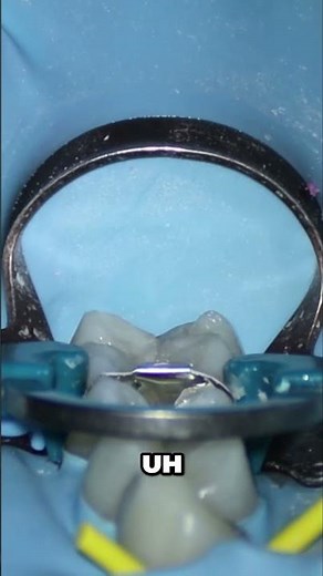 Dental Matrix Ring Perfect Tooth Adaptation Technique