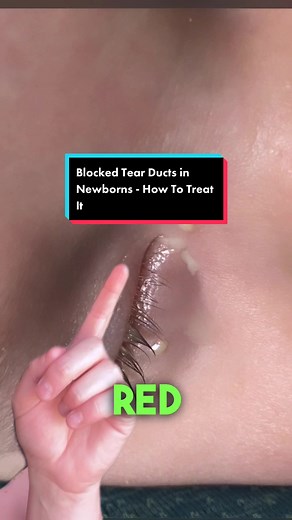 Blocked Tear Ducts in Newborns: Treatment & Massage
