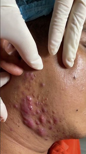 MỤN BỌC , MỤN VIÊM - ACNE REMOVAL tại HHV CLINIC | #53 #shorts