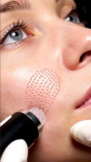 Extreme close-up cystic acne removal #satisfying #blackheadcaique #pimplepopping