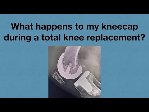 Will They Replace Your Kneecap Too? The Truth