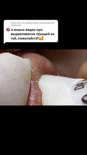 Ответ пользователю @manbrton #blackheads #pimple #pimplepopping #satisfaction #прыщи #давитьпрыщи #угри #чёрные точки #acne