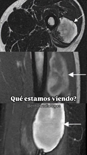 Evolución de la Hemoglobina en Resonancia Magnética