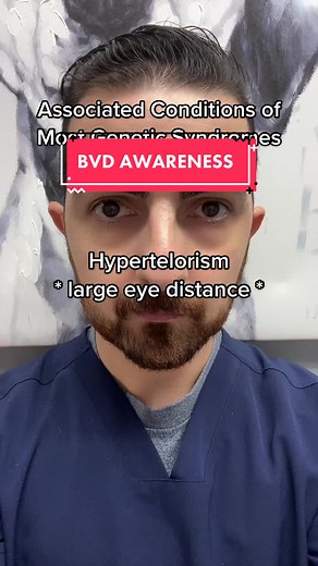 Large or Small Eye Distances are associated with many congenital and genetic syndromes. #hypertelorism #fyp #hypotelorism #eyedistance