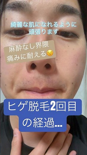 ヒゲ脱毛2回目行ってきました！#脱毛#湘南美容外科 #肌綺麗になりたい