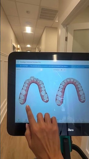 Invisalign simulated outcome and smile architect on new itero lumina #itero #lumina #invisalign