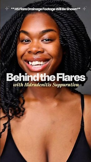 HIDRADENITIS SUPPURATIVA: FLARE UPS! 😳 #hidradenitissuppurativa
