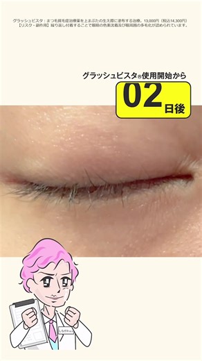 まつ育の新定番・グラッシュビスタ®️ 「でも本当に伸びるの？」「どれくらい効果が出るの？」などの疑問を解決💡 伸びる過程とその仕組みを初登場のしながわ先生が解決します✨ #品川美容外科 #品川スキンクリニック #綺麗になるお手伝い #まつ毛美容液おすすめ教えて #まつ毛美容液の効果 #まつげ美容液おすすめ #なりたい自分になろう#なりたい自分になろうᅠᅠᅠᅠ #美容 #美容外科 #まつ毛 #まつげ #まつ毛美容液 #まつげ美容液 #まつ育 #マツ育 #育毛 #育毛剤 #グラッシュビスタ #症例 #症例写真 #医師監修 #ビフォーアフター #品川 #しながわ #まつげ美容液レビュー