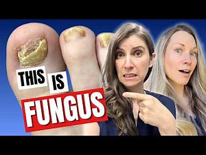 8 Signs You Have Toenail Fungus And What To Do Next