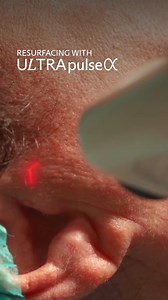 There’s a beautiful confidence that comes with precision. ULTRApulse Alpha supports controlled resurfacing when experience and accuracy matter most, especially in delicate areas where thoughtful technique makes all the difference. Care led by Dr. Manuela Pili at MP Clinics. #LumenisAesthetics #Lumenis #ULTRApulseAlpha #ClinicalAesthetics #EnergyBasedDevices | Lumenis Aesthetic