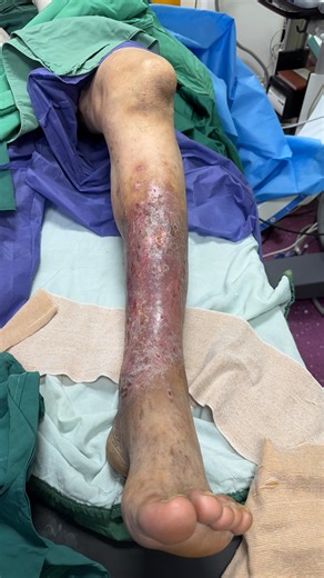 ‎دکتر مقداد قاسمی گرجی فوق تخصص جراح عروق ، آنژیوگرافی و واریس‎ on Instagram‎: "پس از ۱۴ عمل به ما رسید . #دکترمقدادقاسمی #دکترقاسمی #دکتر_قاسمی #جراحی #جراحی_عروق #عروق #رگ #شریان #ورید #واریس #کاروتید #آموزش #پزشکی #اندوواسکولار #آنژیوگرافی #آنوریسم #آنژیوپلاستی ‏#vascularsurgeyir ‏#meghdad #drmeghdadghasemi #dr_ghasemi #dr_meghdadghasemi #vascularsurgery.ir #surgeon #surgery #varicose #endovascular #education #angiography #carotid"‎