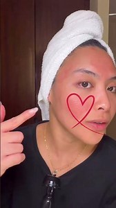 Working on my 9 year old acne scars tonight. Here's how I do it. #acne #acnescarring #microneedling
