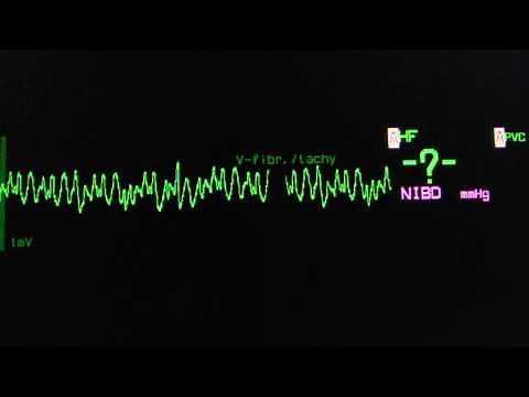 coarse ventricular fibrillation on an ECG heart monitor