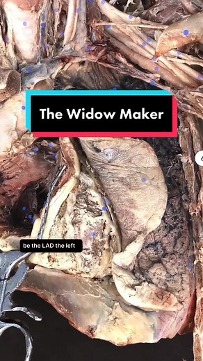 Widowmaker Heart Attack: Anatomy & Causes